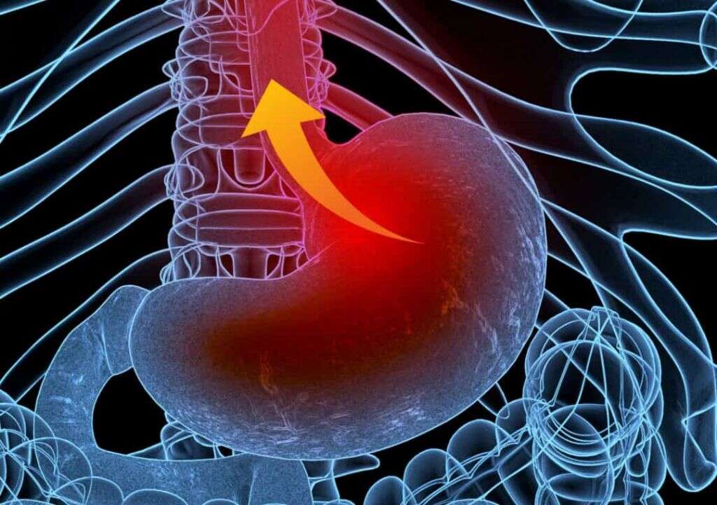 Stress Ulcer