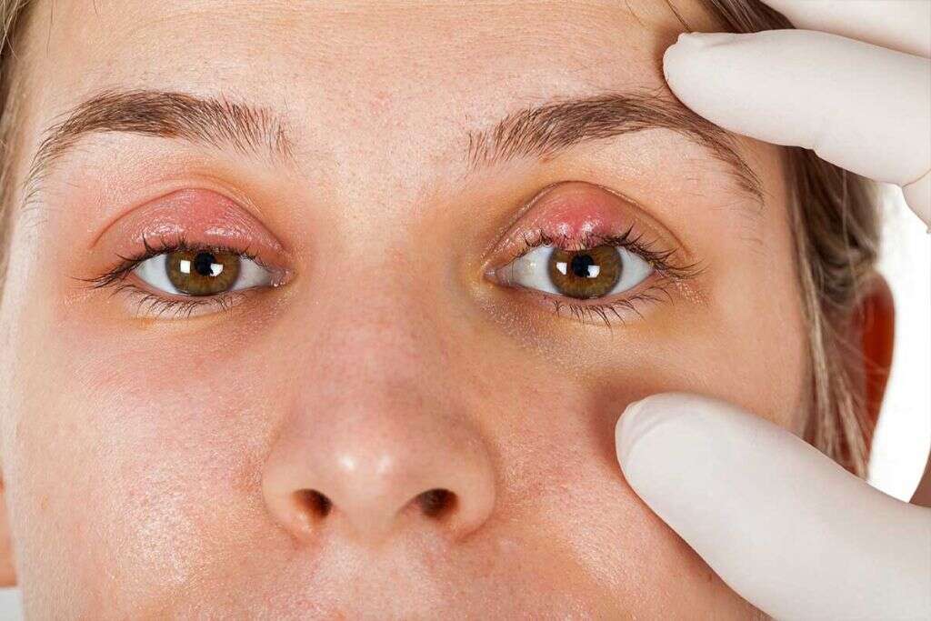 Stye
