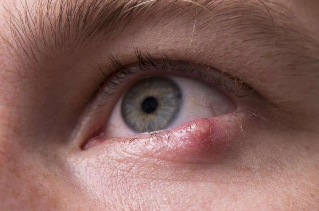 Stye