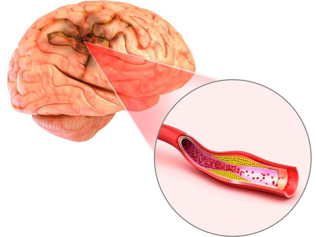 Subarachnoid Hemorrhage