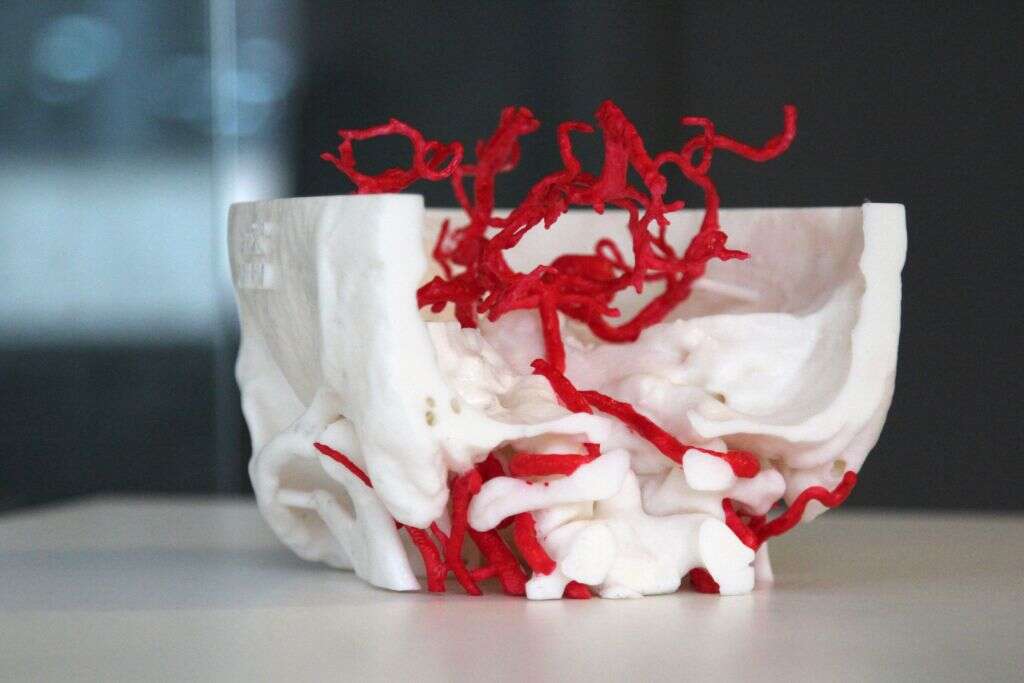 Subarachnoid Hemorrhage
