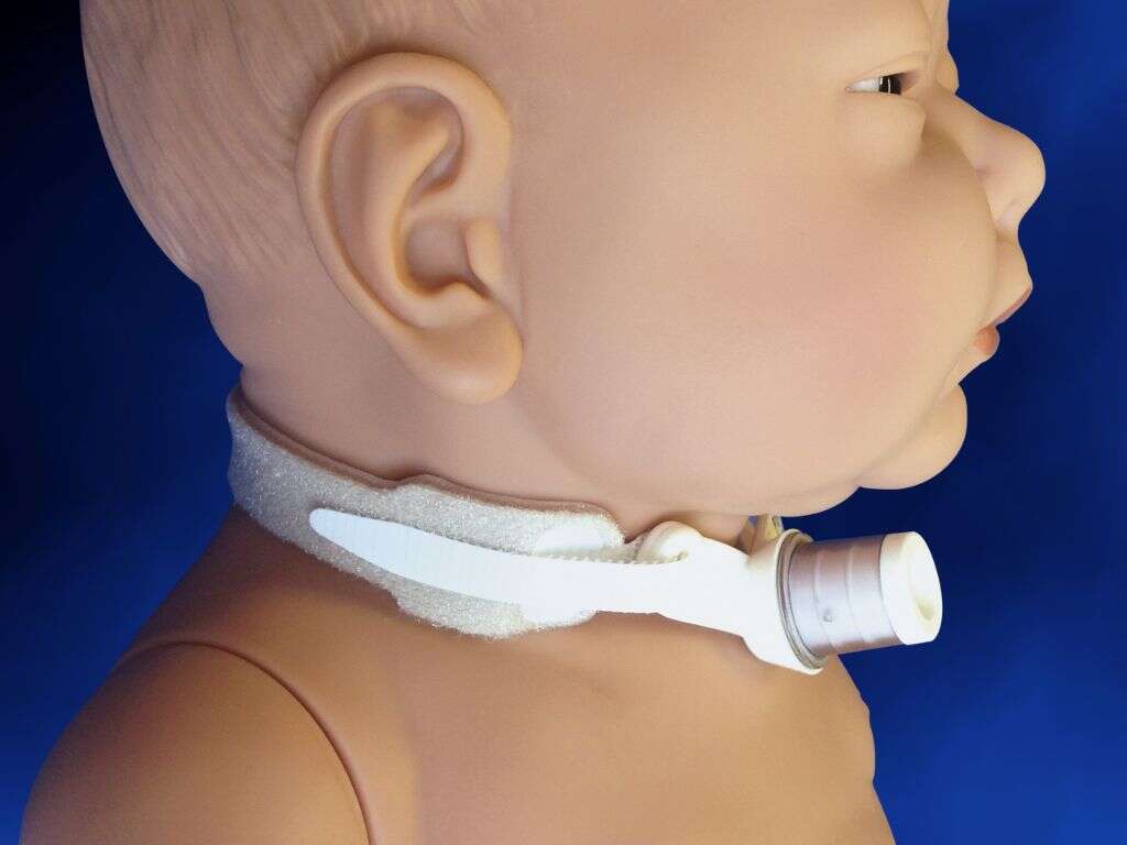 Tracheostomy