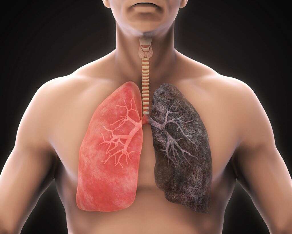 Tracheostomy
