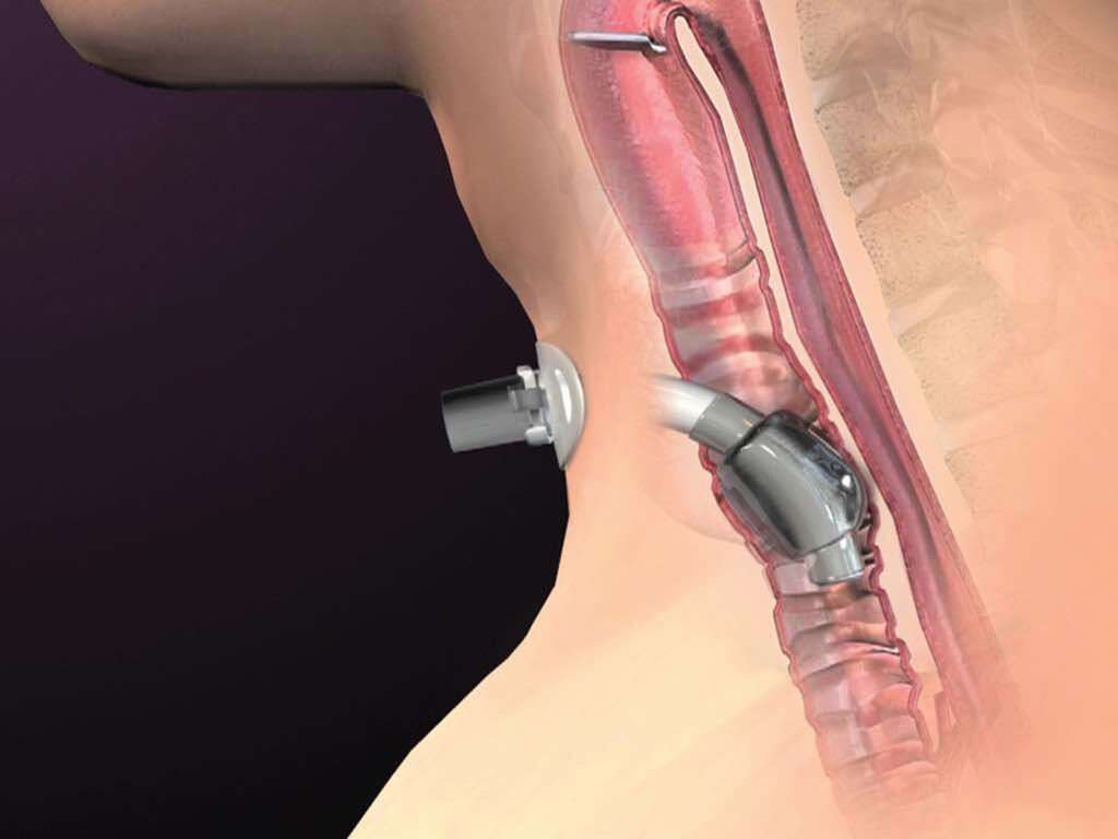 Tracheostomy