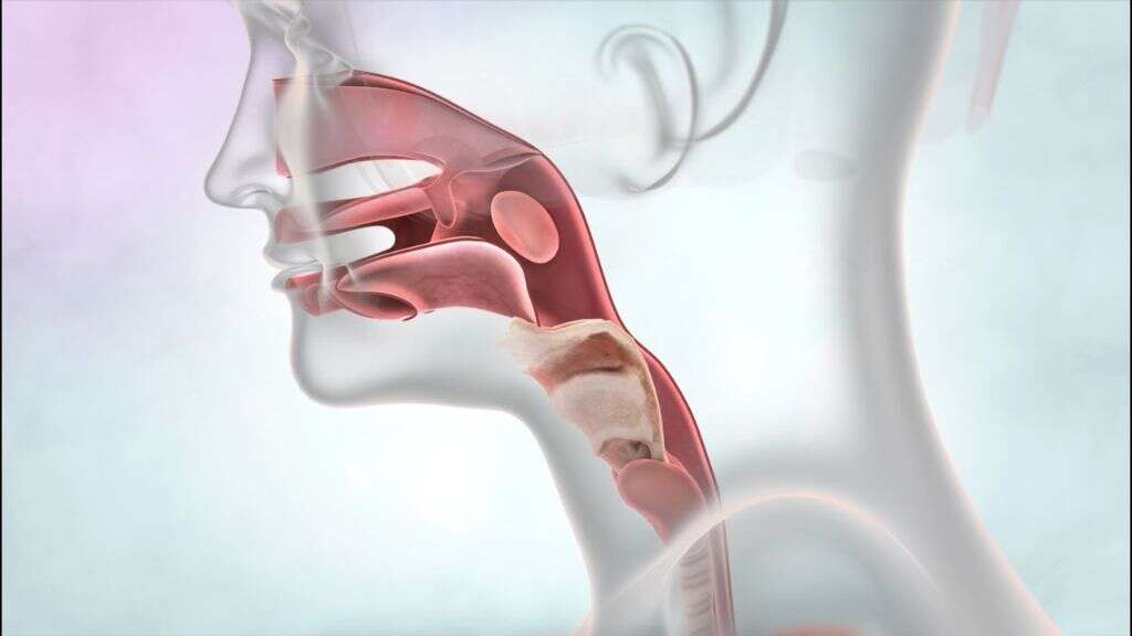 Tracheostomy