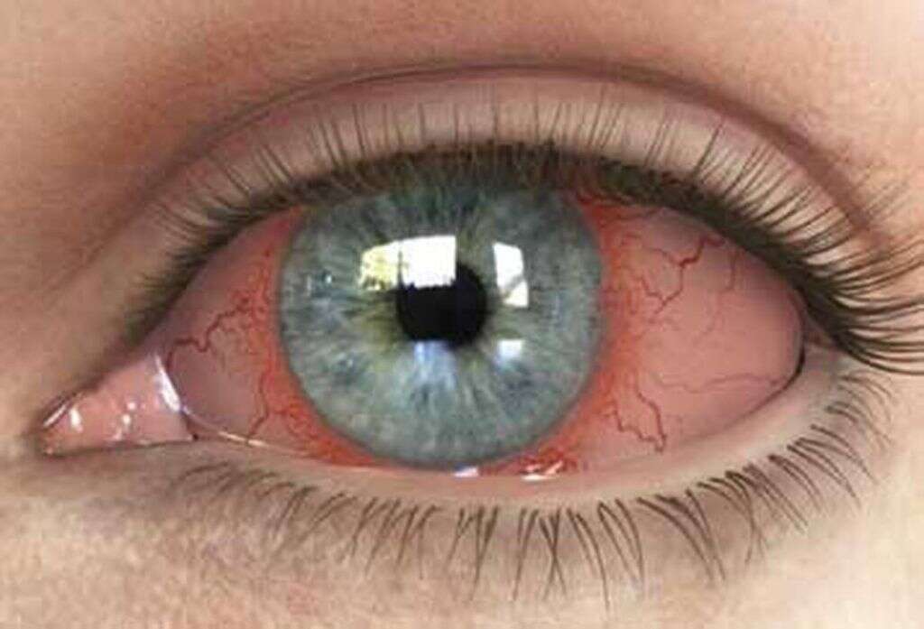 Uveitis