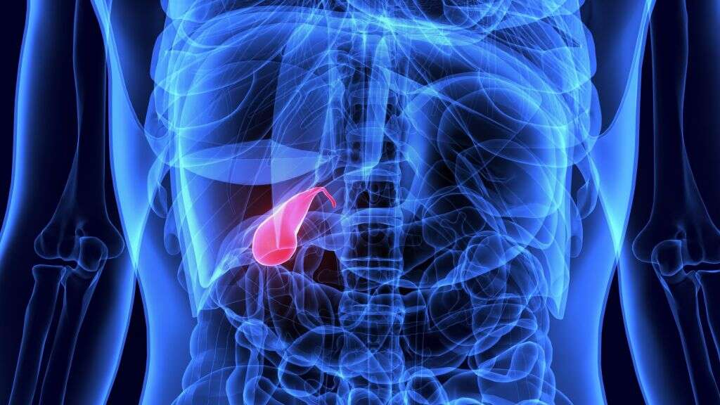 Acute Cholecystitis