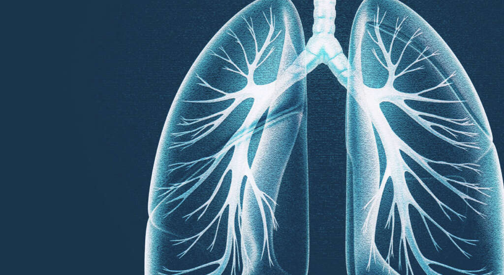 Acute Respiratory Distress Syndrome