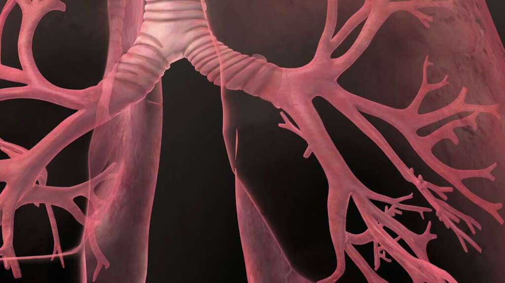 Acute Respiratory Distress Syndrome