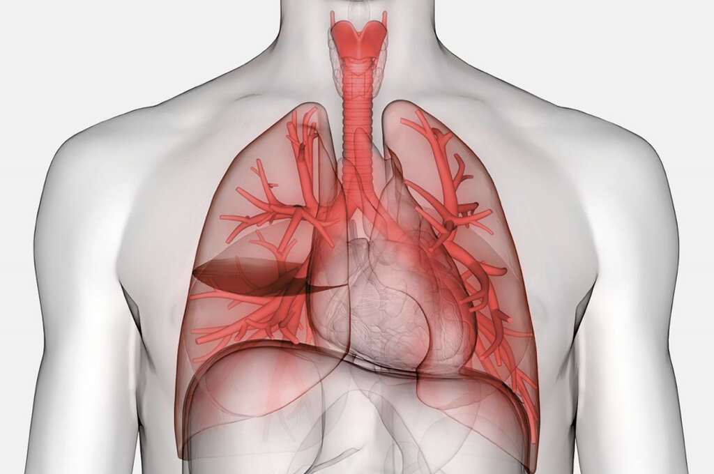 Acute Respiratory Distress Syndrome