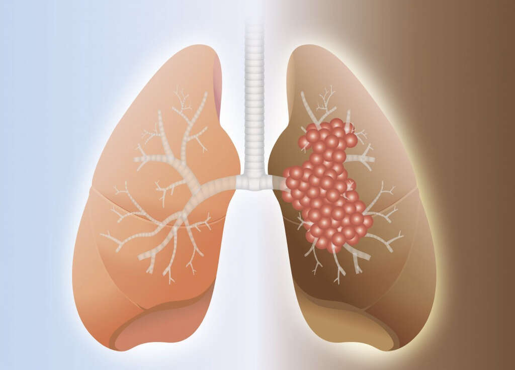 Acute Respiratory Distress Syndrome