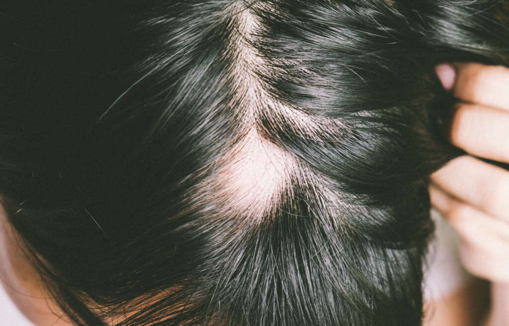 Alopecia Areata