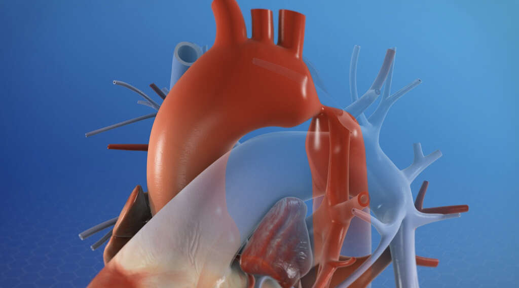Aortic Aneurysm