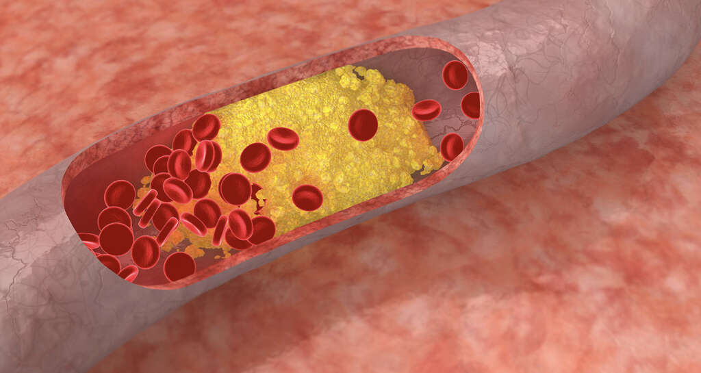 Aortic Aneurysm