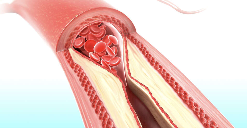 Atheroma