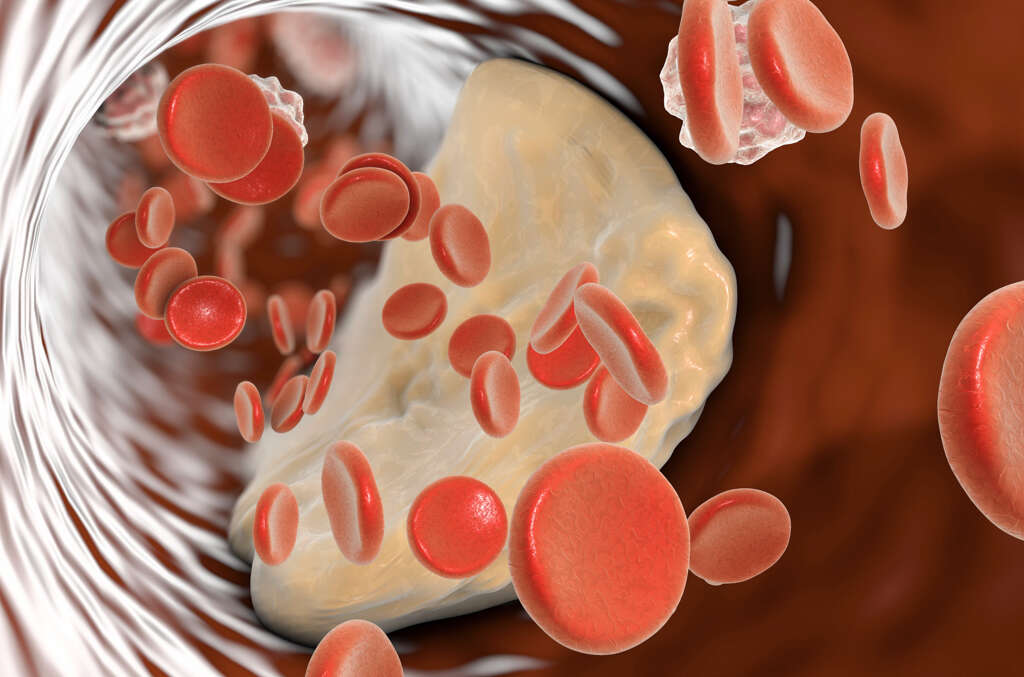 Atheroma
