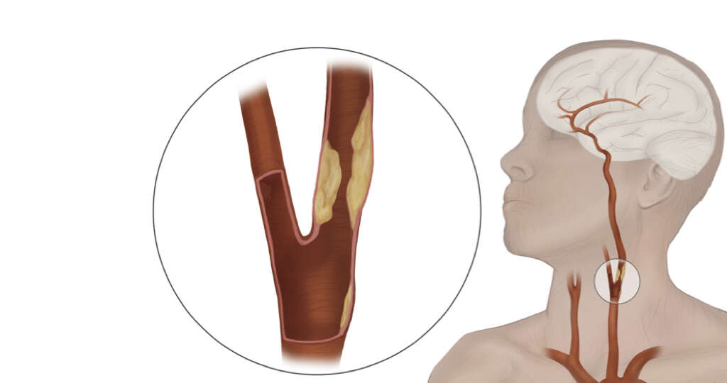 Atheroma