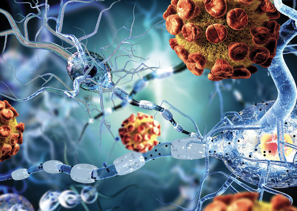Autoimmune Disease