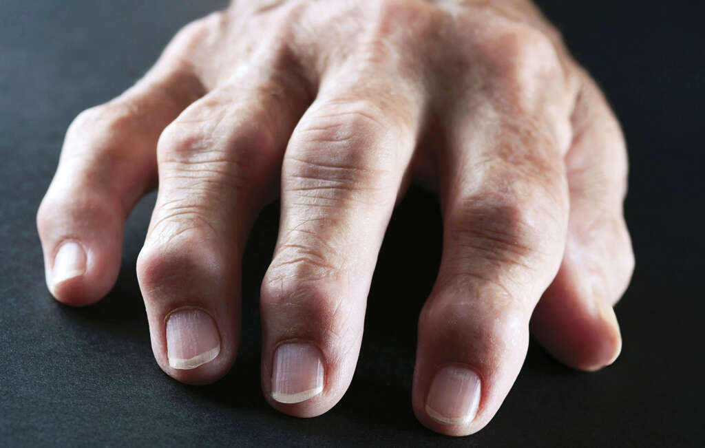 Autoimmune Disease