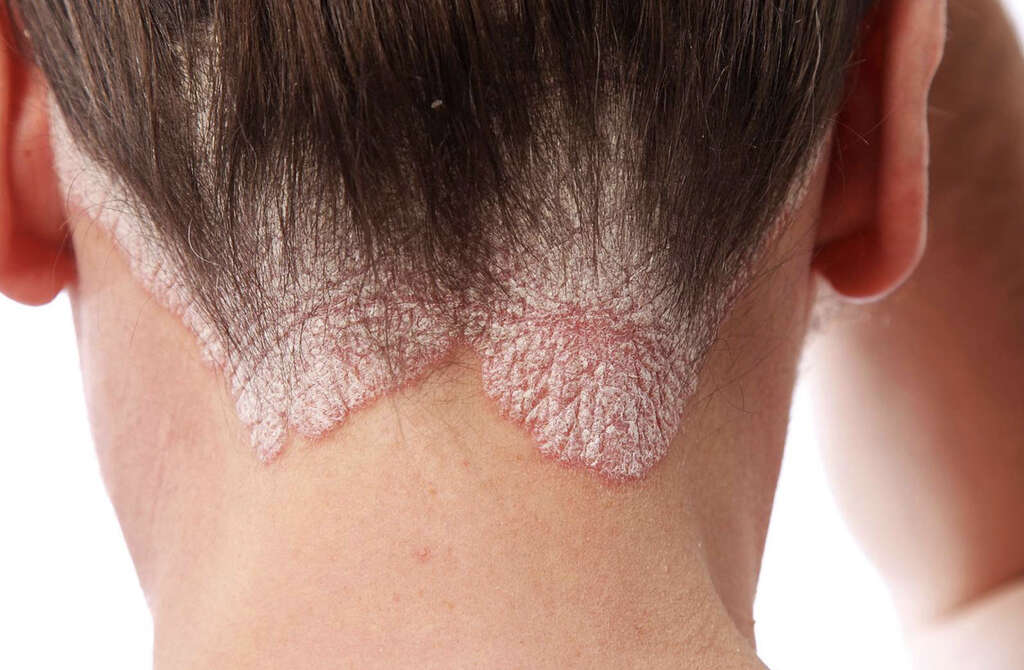 Autoimmune Disease