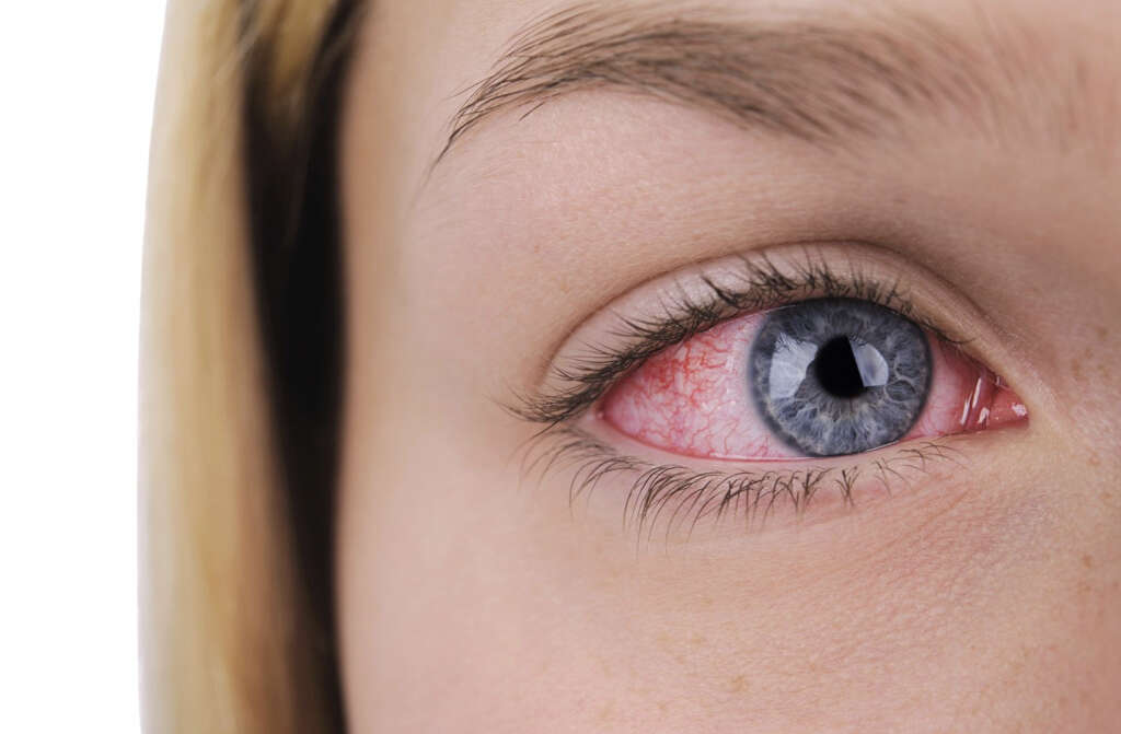 Eye Spasm