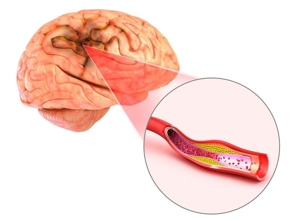 Ischemic Stroke