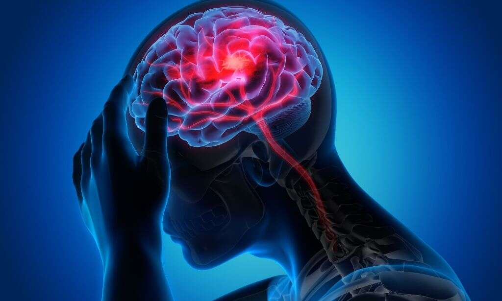 Ischemic Stroke