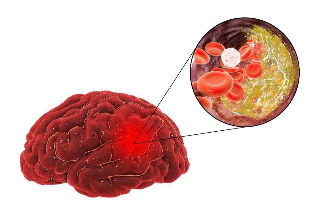 Ischemic Stroke