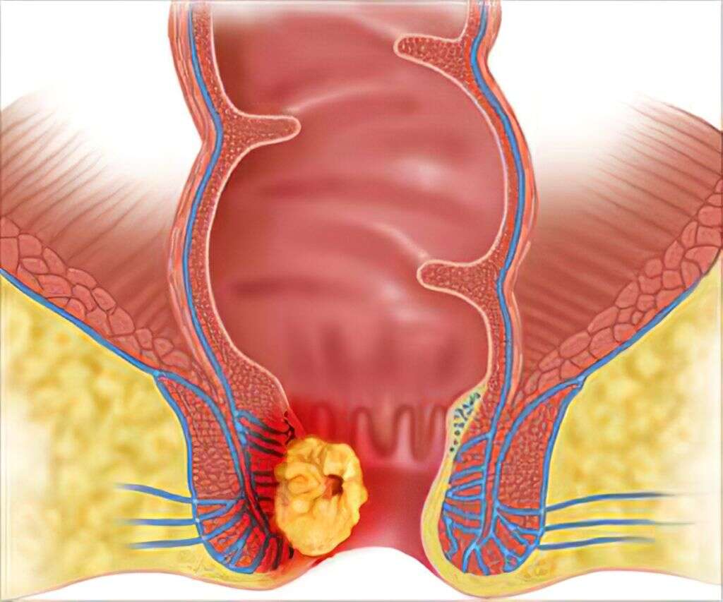 Anal Cancer