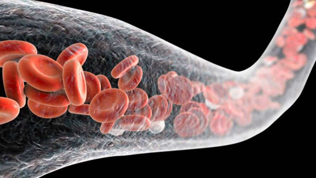 Anemia