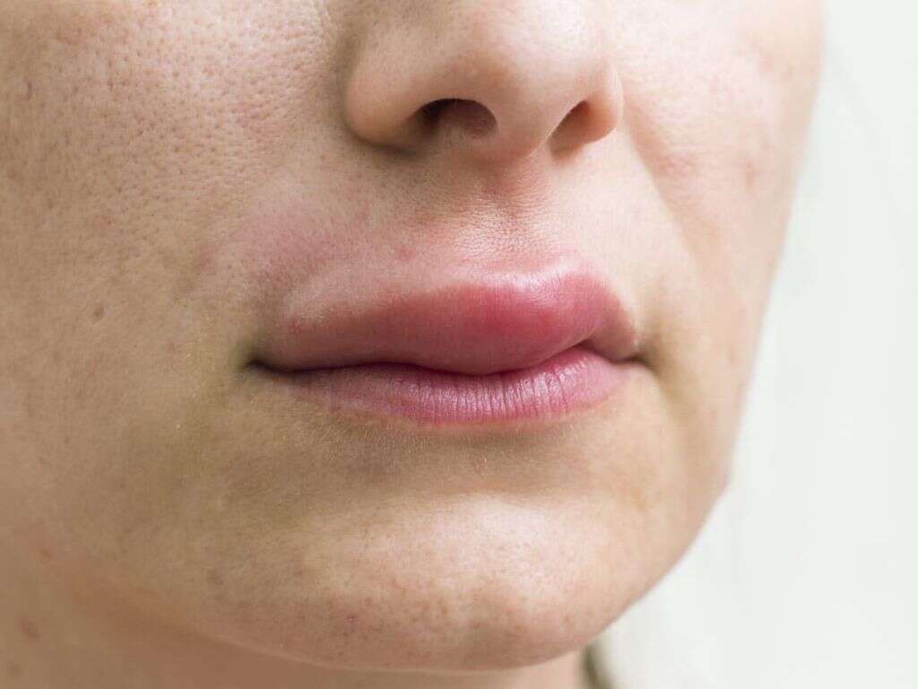 Angioedema