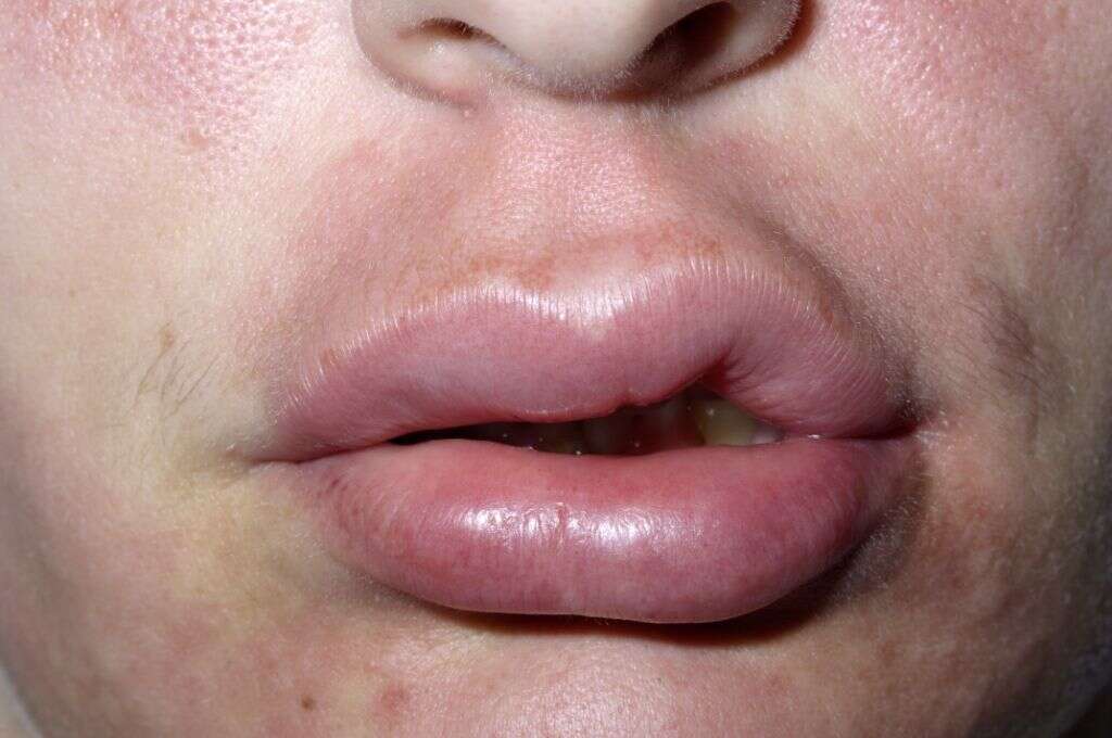 Angioedema