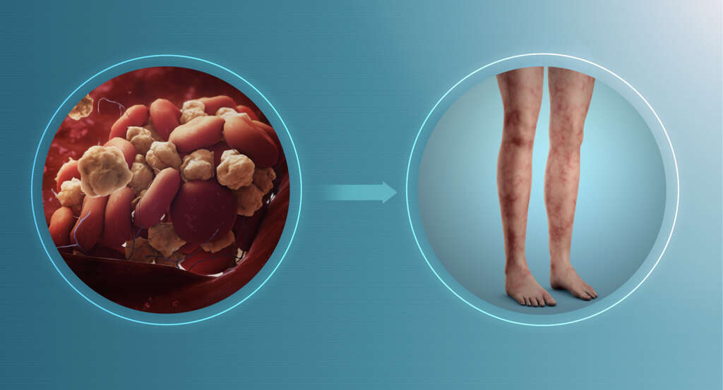Antiphospholipid Syndrome