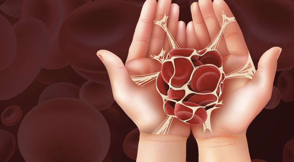 Antiphospholipid Syndrome
