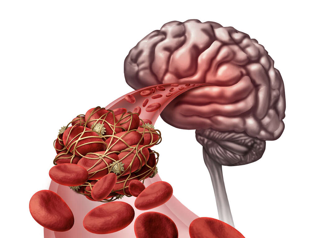 Antiphospholipid Syndrome