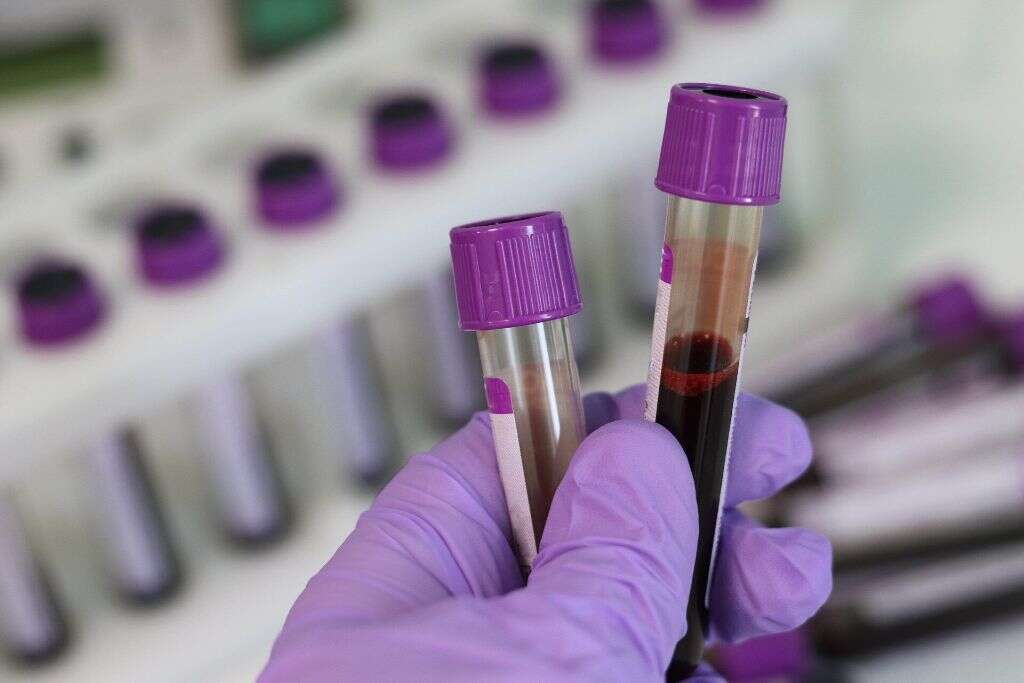Aplastic Anemia