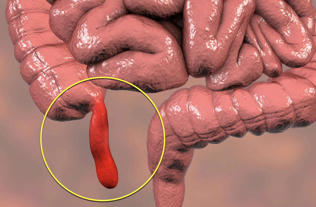 Appendicitis