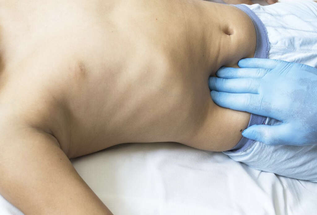 Appendicitis