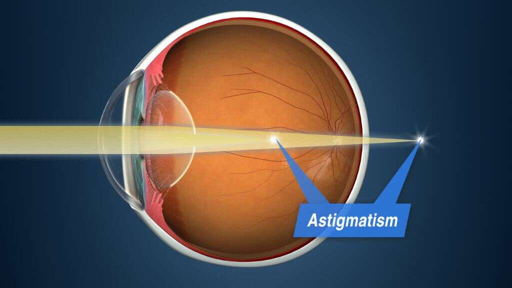 Astigmatism