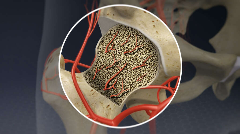 Avascular Necrosis