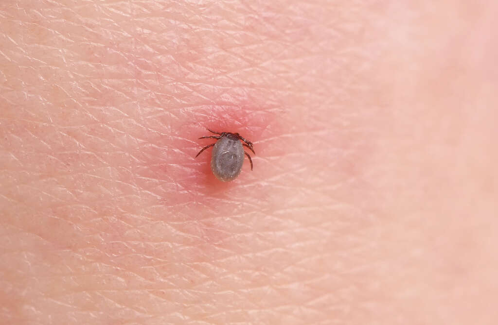 Babesiosis