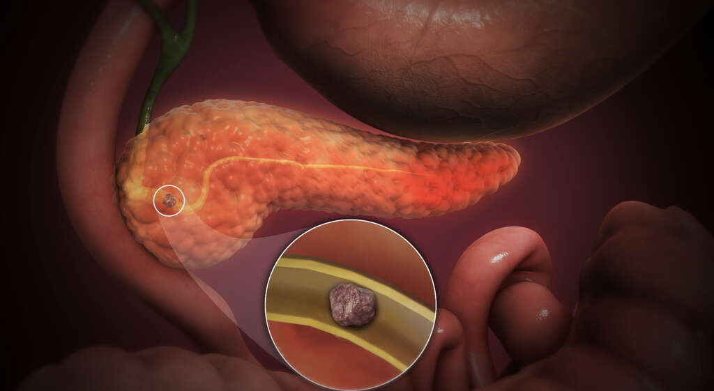 Biliary Colic