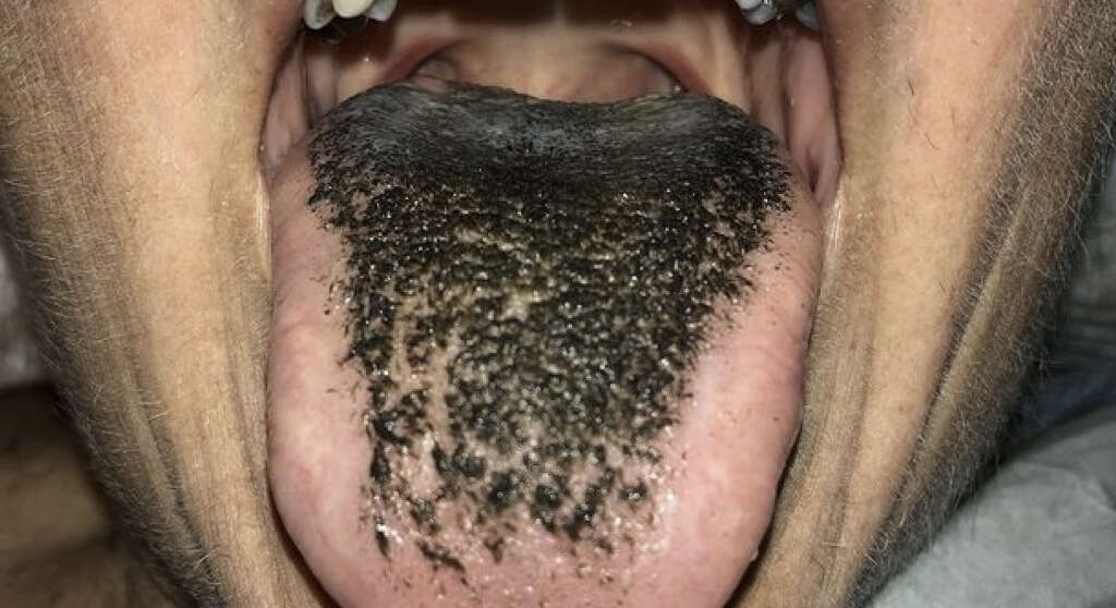 Black Hairy Tongue