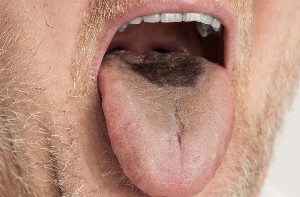 Black Hairy Tongue