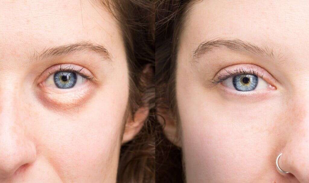 Blepharitis