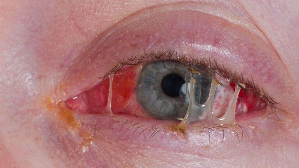 Blepharitis