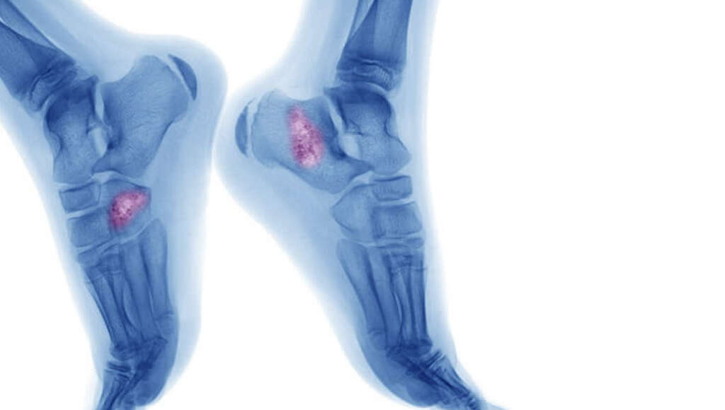 Bone Cancer