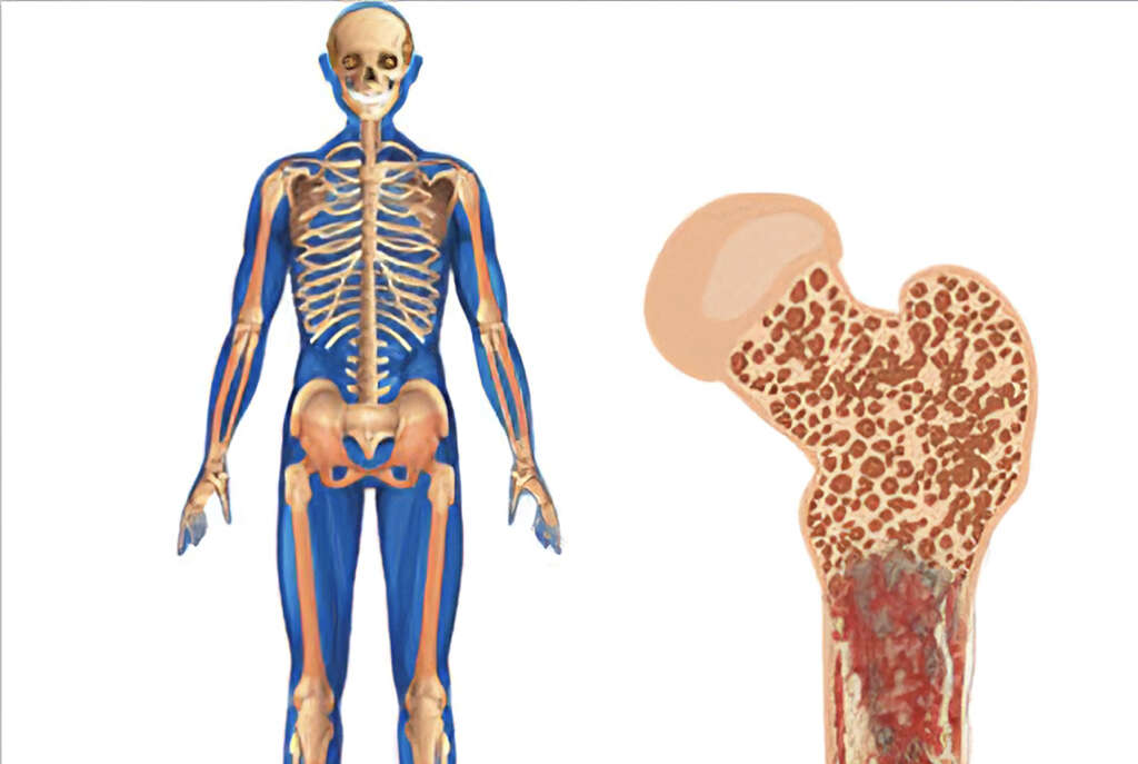Bone Cancer