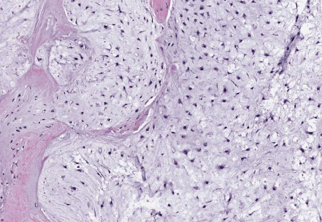 Bone Cancer