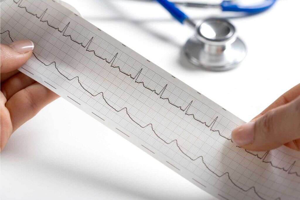 Brugada Syndrome